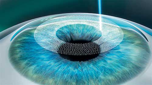 LASIK-Operation, Augenlasern, Lohr