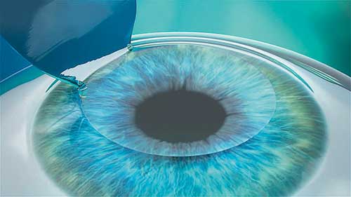 LASIK-Operation, Augenlasern, Lohr