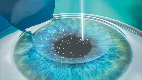 LASIK-Operation, Augenlasern, Lohr