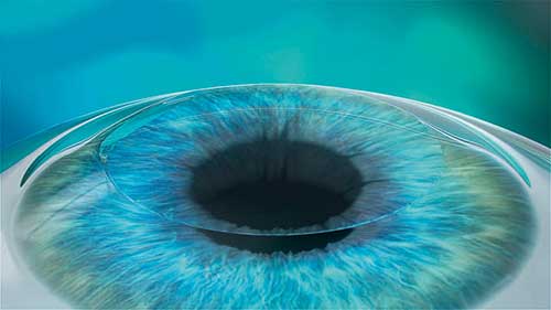 LASIK-Operation, Augenlasern, Lohr
