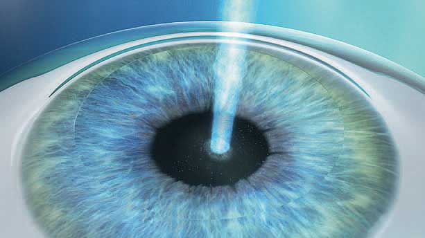 PRK, LASEK-Operation, Augenlasern, Lohr